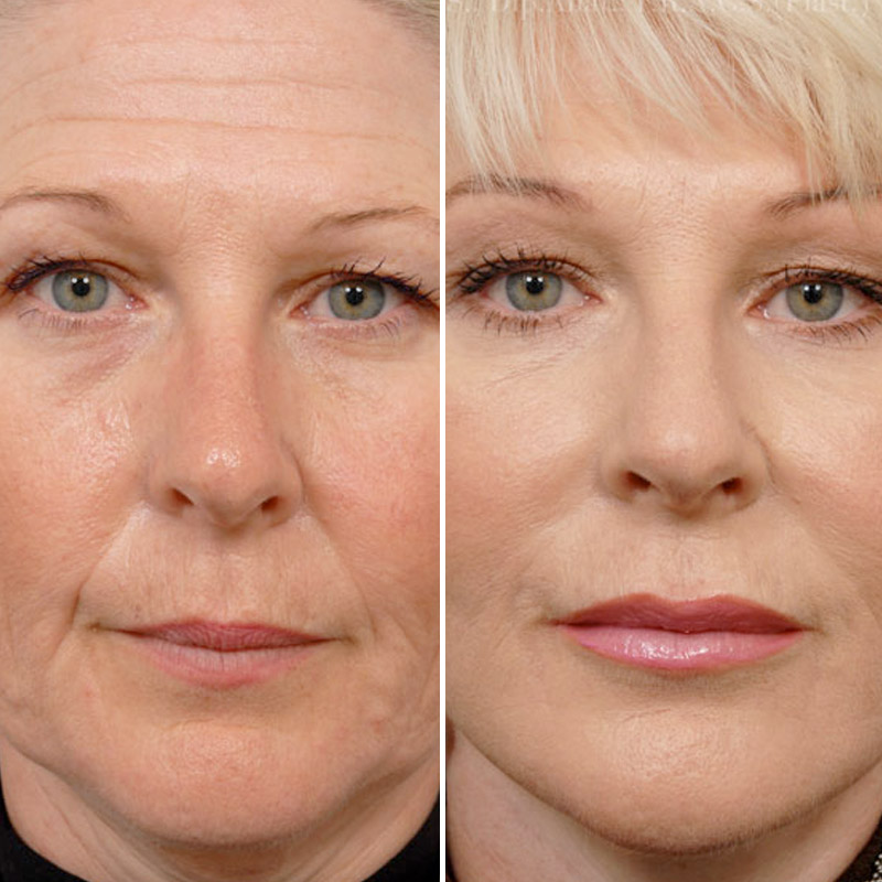 Hifu Non Surgical Face Lift Ipswich Before The Lines
