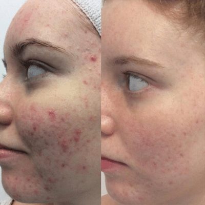 Microdermabrasion Ipswich Before and After