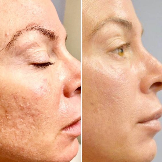 EPN Microneedling Ipswich, Skin Rejuvination | Before The Lines