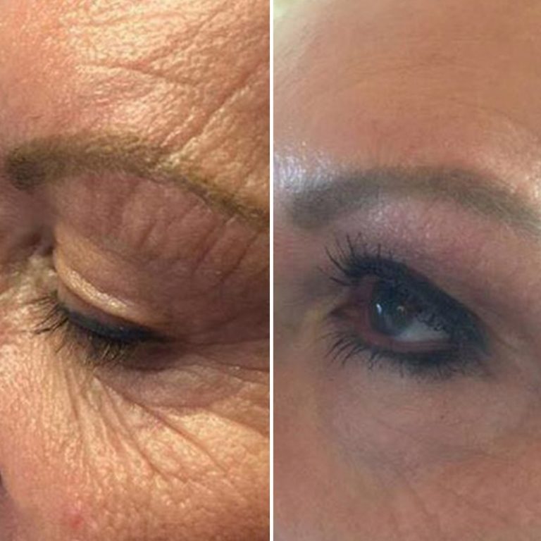 Plasma Pen Fibroblasting Skin Tightening Ipswich Before The Lines