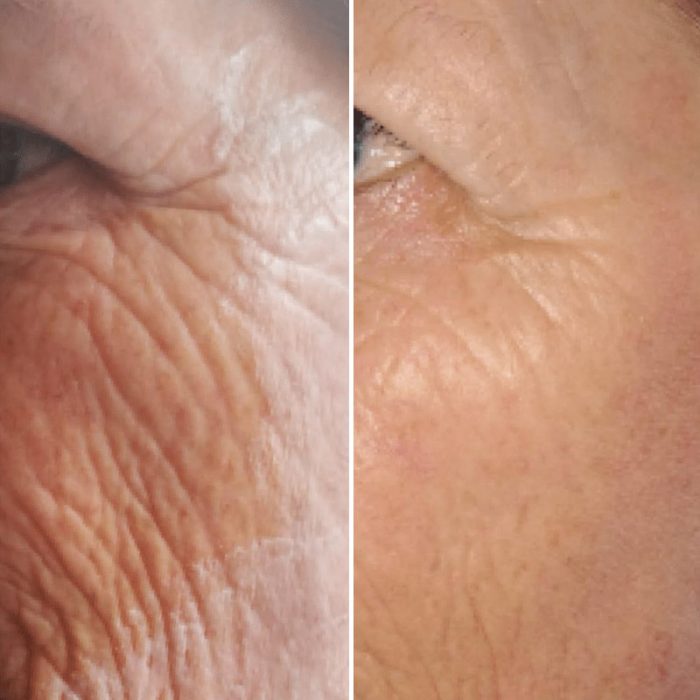 Plasma Pen Fibroblasting Skin Tightening Ipswich Before The Lines