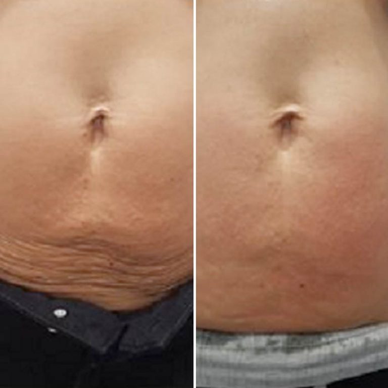 Body Cavitation / Cellulite Reduction Ipswich | Before the Lines